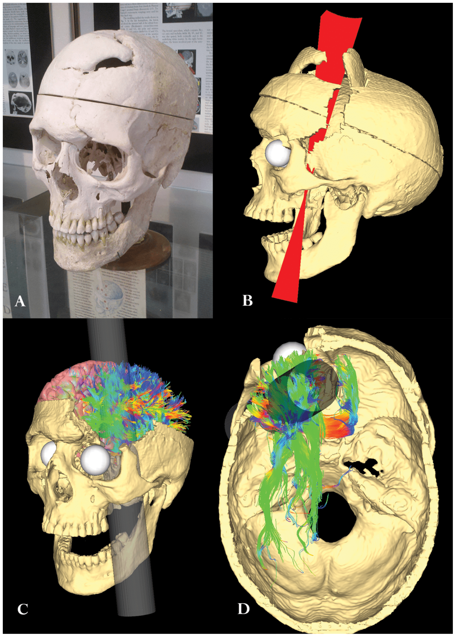 Simulated Connectivity Damage of Phineas Gage